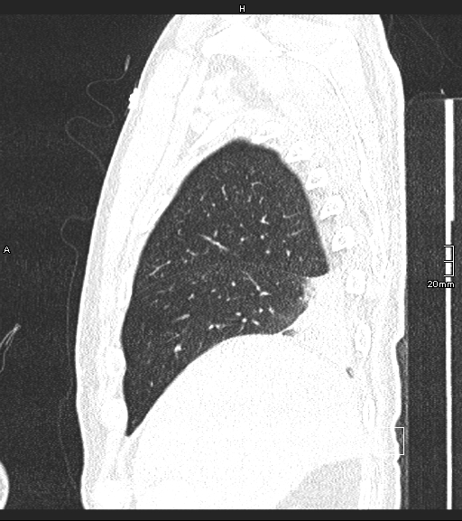 Acute aspiration pneumonitis (Radiopaedia 55642-62166 Sagittal lung window 131).jpg