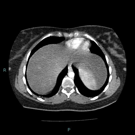 Acute bilateral pyelonephritis (Radiopaedia 37146-38881 Axial C+ arterial phase 12).jpg