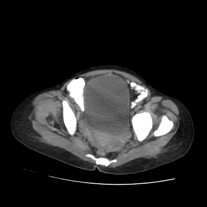 File:Acute calculous cholecystitis in patient with osteopetrosis (Radiopaedia 77871-90159 Axial non-contrast 70).jpg