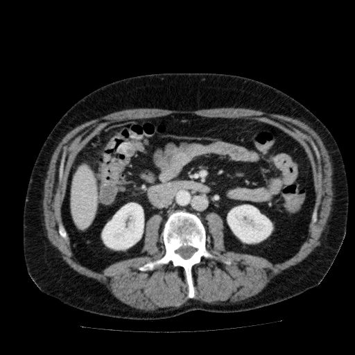 Acute cholecystitis and incidental left sided IVC (Radiopaedia 49352-54459 Axial C+ portal venous phase 76).jpg