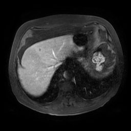 Acute cholecystitis complicated by pylephlebitis (Radiopaedia 65782-74915 Axial arterioportal phase T1 C+ fat sat 15).jpg