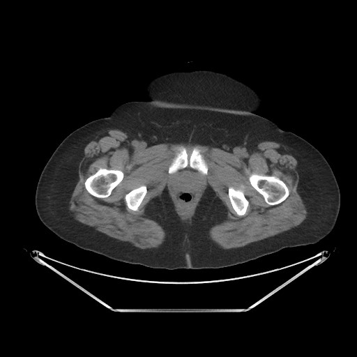File:Acute cholecystitis with tensile fundus sign (Radiopaedia 71394-81723 Axial non-contrast 122).jpg