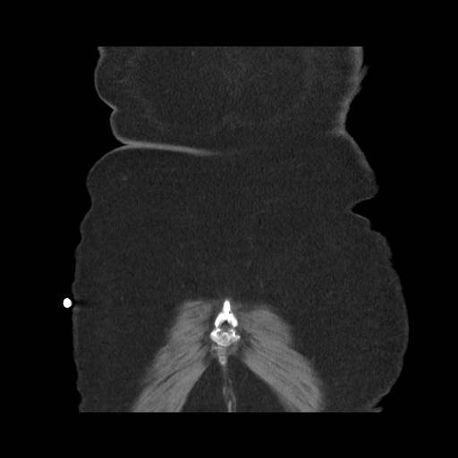 Acute cholecystitis with tensile fundus sign (Radiopaedia 71394-81723 Coronal non-contrast 116).jpg