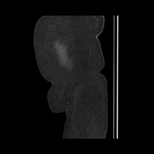 Acute cholecystitis with tensile fundus sign (Radiopaedia 71394-81723 Sagittal non-contrast 157).jpg