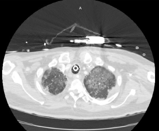 Acute cor pulmonale (ultrasound) (Radiopaedia 83508-98818 Axial lung window 13).jpg