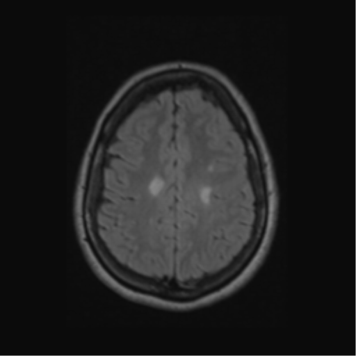 Acute disseminated encephalomyelitis (ADEM) (Radiopaedia 38073-40065 Axial FLAIR 50).png