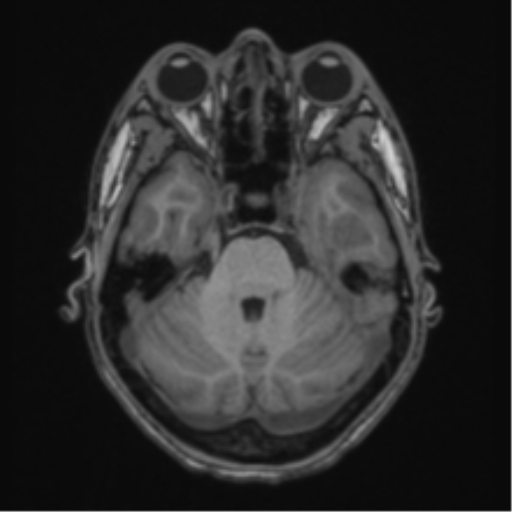 Acute disseminated encephalomyelitis (ADEM) (Radiopaedia 65319-74349 Axial T1 16).png