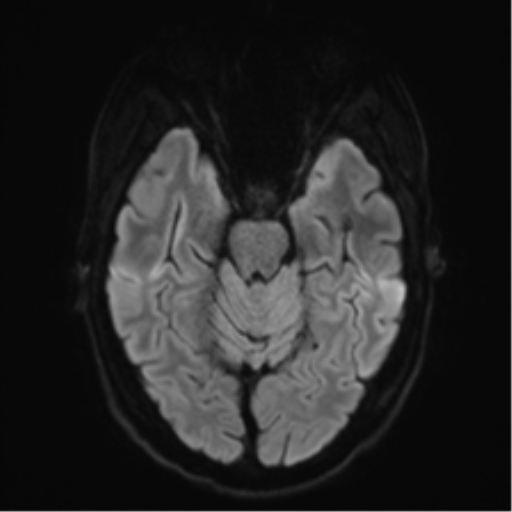File:Acute disseminated encephalomyelitis (ADEM) (Radiopaedia 65319-74350 Axial DWI 9).png