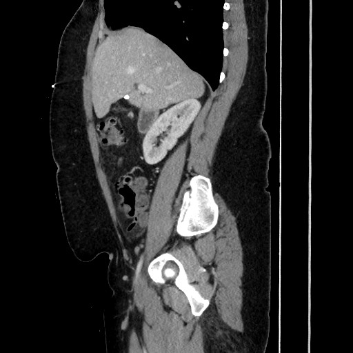Acute diverticulitis - transverse colon (Radiopaedia 87063-103327 Sagittal C+ portal venous phase 92).jpg