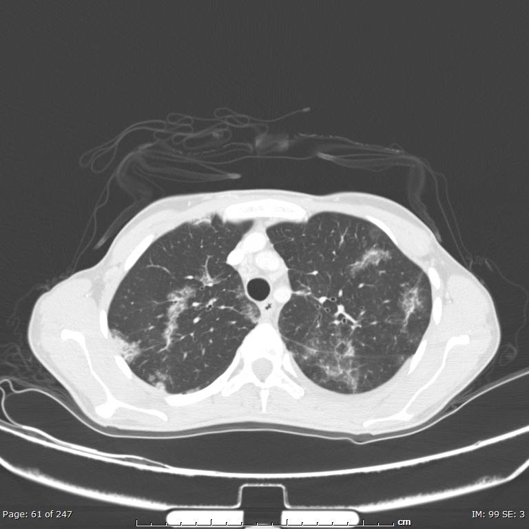 Acute eosinophilic pneumonia (Radiopaedia 48211-53073 Axial lung window 22).jpg
