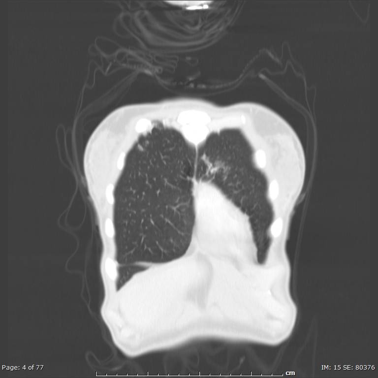 Acute eosinophilic pneumonia (Radiopaedia 48211-53073 Coronal lung window 1).jpg