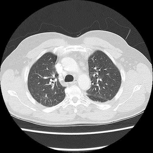 File:Acute epicardial fat necrosis (Radiopaedia 42327-45440 Axial lung window 22).jpg