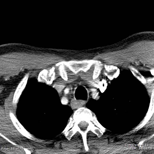 Acute epiglottitis (Radiopaedia 54375-60590 Axial C+ arterial phase 66).jpg