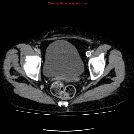 Acute gangrenous cholecystitis (Radiopaedia 10123-10661 Axial C+ portal venous phase 93).jpg
