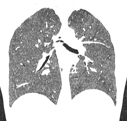 Acute hypersensitivity pneumonitis (Radiopaedia 85293-100870 Coronal lung window 78).jpg