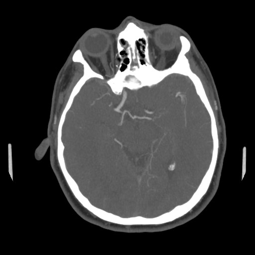 File:Acute internal carotid artery dissection (Radiopaedia 53541-59630 D 34).jpg