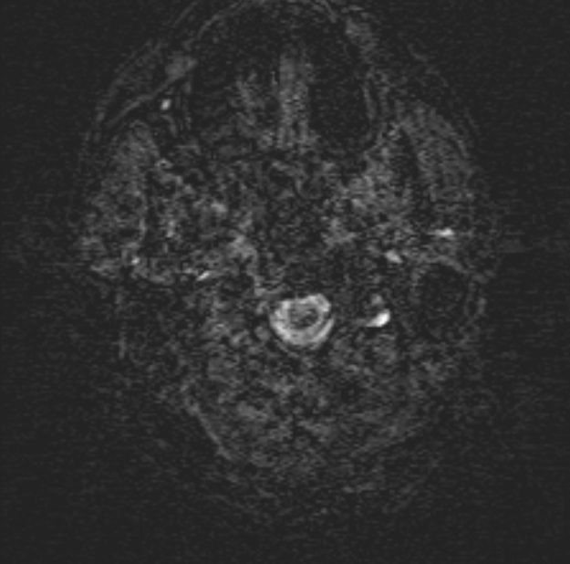 Acute ischemic stroke - posterior circulation territory (Radiopaedia 77670-89880 Axial SWI 1).jpg