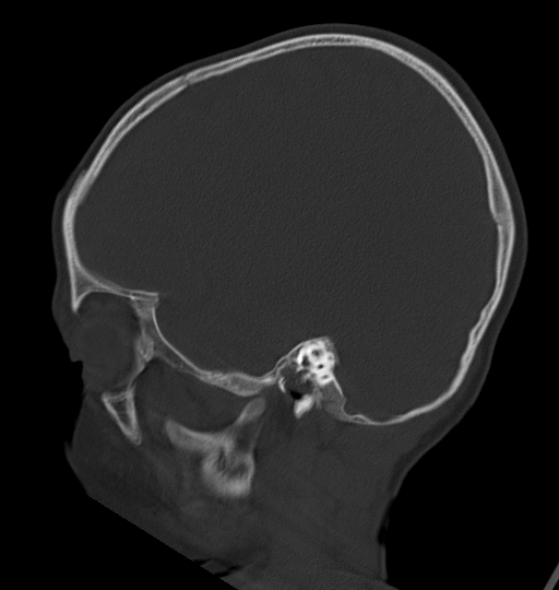 Acute mastoiditis (Radiopaedia 82678-96881 Sagittal bone window 49).jpg