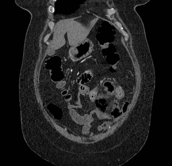 Acute mesenteric ischemia (Radiopaedia 80029-93316 Coronal C+ arterial phase 22).jpg