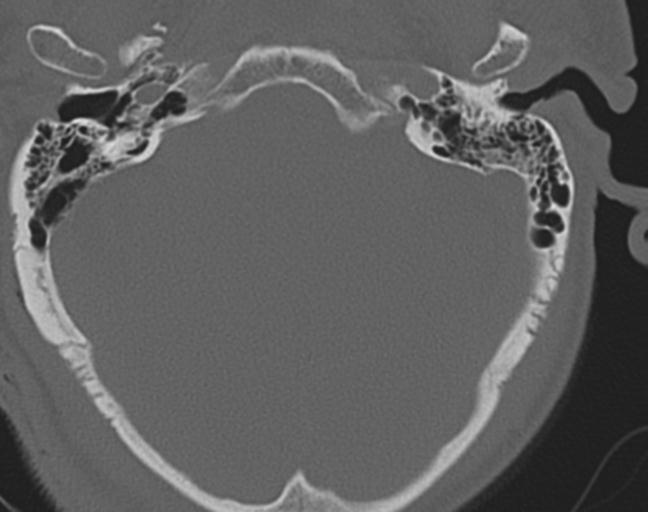 Acute on chronic subdural hematoma and thoracic vertebral injury in a multitrauma patient (Radiopaedia 31698-32619 Axial bone window 3).jpg