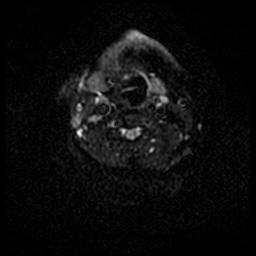 Acute otitis externa (Radiopaedia 57296-64236 Axial DWI 51).jpg