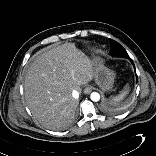 File:Acute pancreatic necrosis (Radiopaedia 13560-13486 Axial C+ portal venous phase 28).jpg