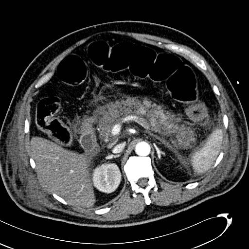 File:Acute pancreatic necrosis (Radiopaedia 13560-13486 Axial C+ portal venous phase 53).jpg