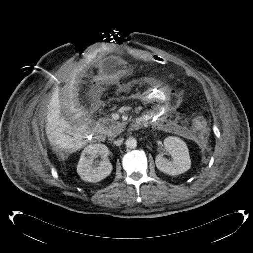 File:Acute pancreatic necrosis (Radiopaedia 13560-18503 Axial C+ portal venous phase 35).jpg
