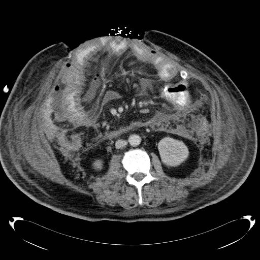 Acute pancreatic necrosis (Radiopaedia 13560-18503 Axial C+ portal venous phase 42).jpg