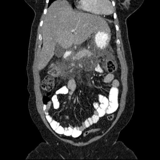 File:Acute pancreatitis (Radiopaedia 20829-20744 Coronal C+ portal venous phase 18).jpg