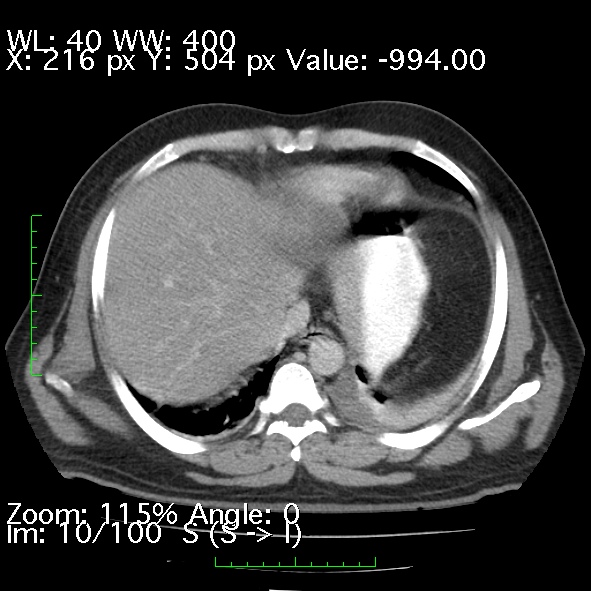 Acute pancreatitis (Radiopaedia 34043-35276 Axial C+ portal venous phase 10).jpg