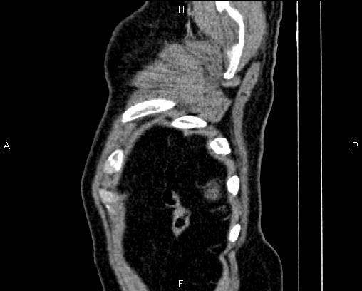 File:Acute pancreatitis (Radiopaedia 85146-100701 Sagittal C+ portal venous phase 92).jpg