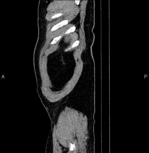 Acute pancreatitis (Radiopaedia 85390-101010 Sagittal C+ portal venous phase 102).jpg