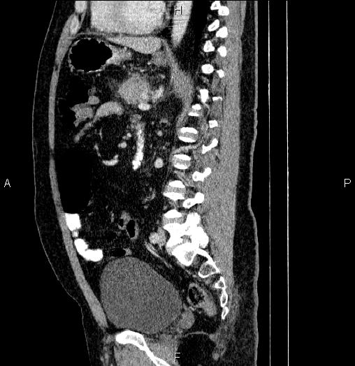 Acute pancreatitis (Radiopaedia 85390-101010 Sagittal C+ portal venous phase 60).jpg