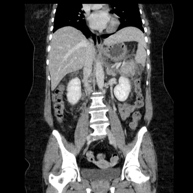 Acute pancreatitis - Balthazar C (Radiopaedia 26569-26714 Coronal C+ portal venous phase 38).jpg