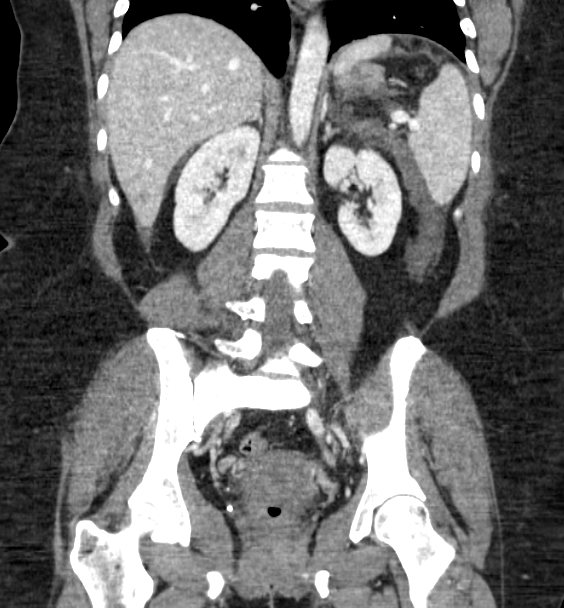 Acute pancreatitis - Balthazar E (Radiopaedia 29016-29377 Coronal C+ portal venous phase 61).png