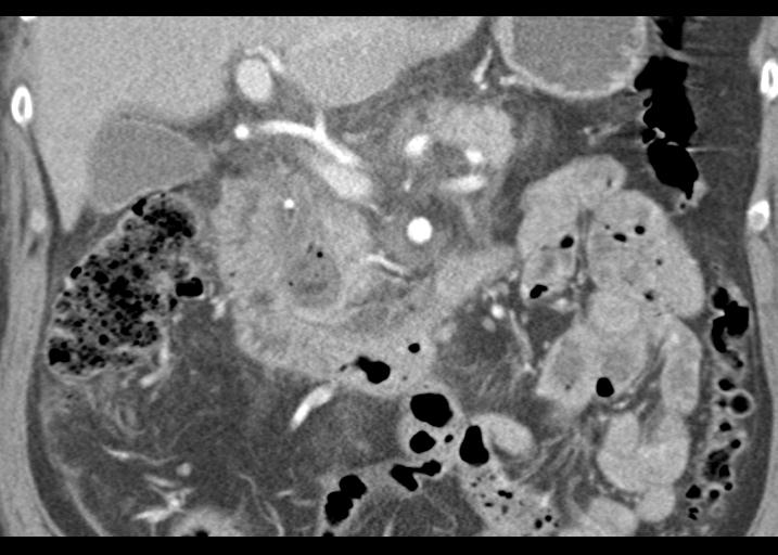 Acute pancreatitis and walled-off necrosis (Radiopaedia 29888-30403 Coronal C+ portal venous phase 27).jpg