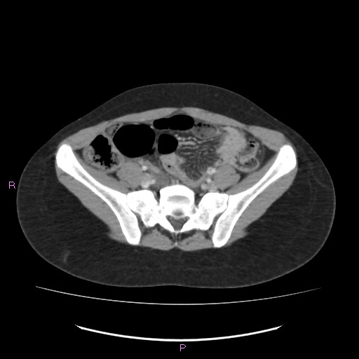 File:Acute pancreatitis secondary to stone at minor papilla and pancreatic divisum (Radiopaedia 76570-88333 Axial C+ portal venous phase 57).jpg