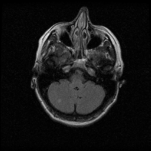 File:Acute pontine infarct from vertebral artery dissection (Radiopaedia 34111-35370 Axial FLAIR 4).png