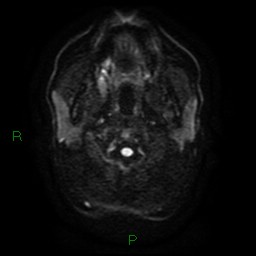 Acute posterior cerebral artery territory infarct (Radiopaedia 79329-92394 Axial DWI 1).jpg
