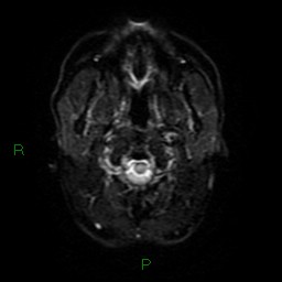 Acute posterior cerebral artery territory infarct (Radiopaedia 79329-92394 Axial DWI 30).jpg