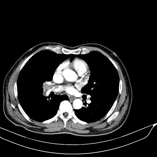 File:Acute pulmonary embolism (Radiopaedia 69510-79390 D 23).jpg