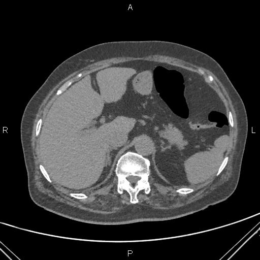 File:Acute renal artery occlusion (Radiopaedia 86586-102682 Axial non-contrast 16).jpg