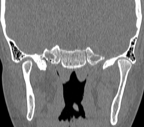 Acute sinusitis (Radiopaedia 40564-43158 Coronal bone window 50).jpg