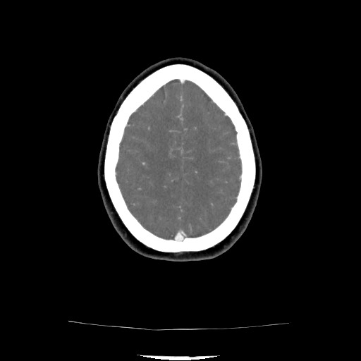 Acute subarachnoid hemorrhage and accessory anterior cerebral artery (Radiopaedia 69231-79009 Axial C+ arterial phase 114).jpg