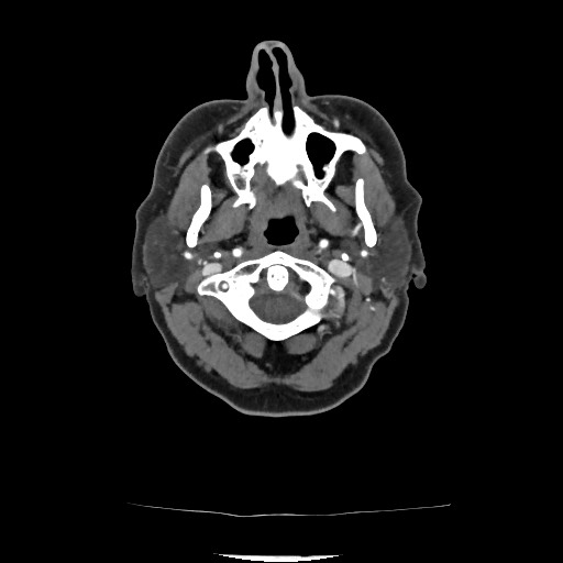 File:Acute subarachnoid hemorrhage and accessory anterior cerebral artery (Radiopaedia 69231-79009 Axial C+ arterial phase 70).jpg