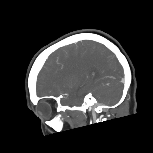 Acute subarachnoid hemorrhage and accessory anterior cerebral artery (Radiopaedia 69231-79009 Sagittal C+ arterial phase 24).jpg