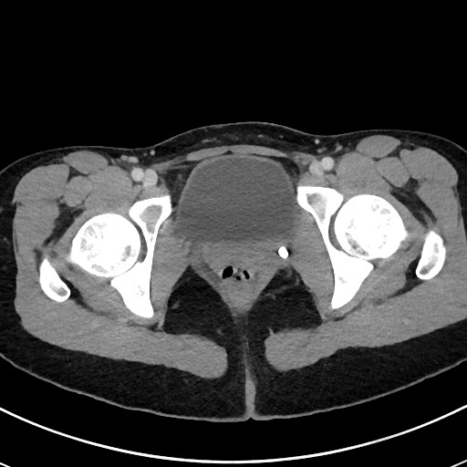 Acute uncomplicated appendicitis (Radiopaedia 61374-69304 Axial C+ portal venous phase 126).jpg