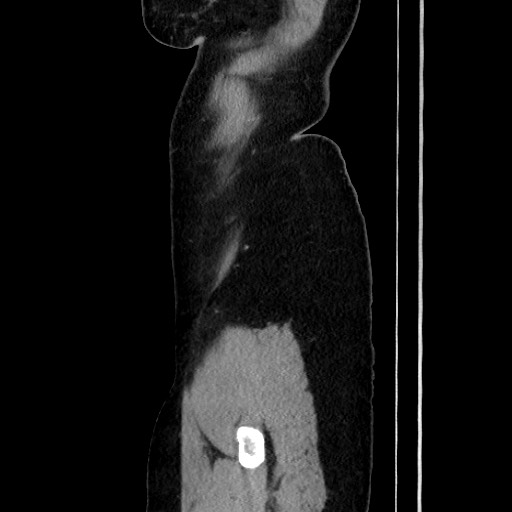 Acute uncomplicated appendicitis (Radiopaedia 73704-84499 Sagittal C+ portal venous phase 43).jpg