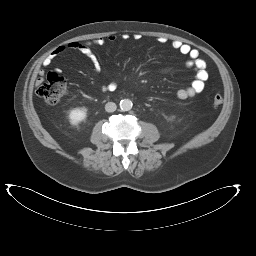 Adenocarcioma of rectum- T1 lesion (Radiopaedia 36921-38547 Axial C+ portal venous phase 46).png